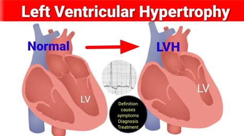 lv of heart|dangers of left ventricular hypertrophy.